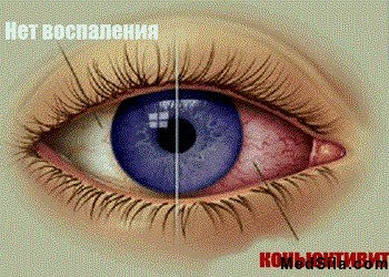 Воспаление конъюнктивы